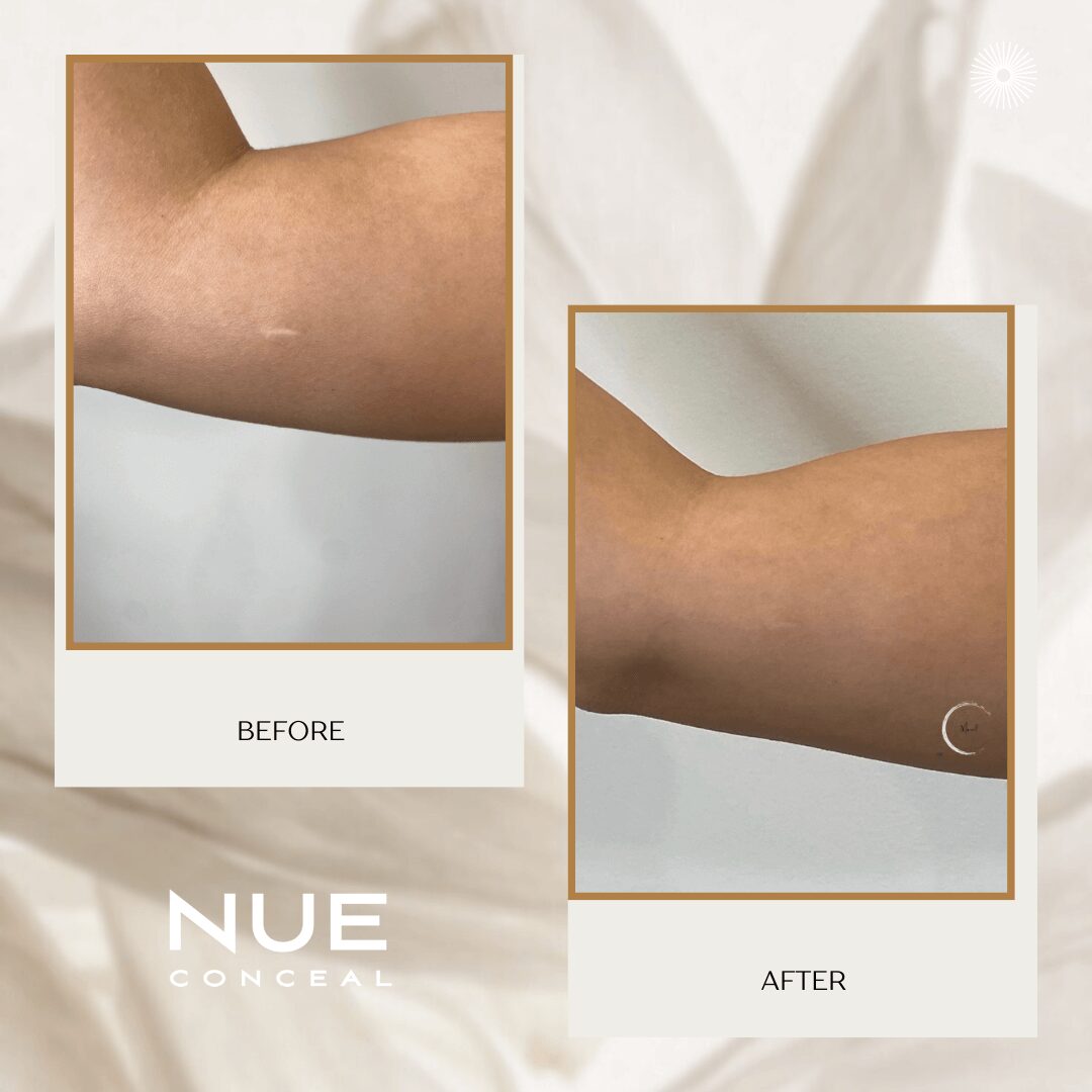 Side-by-side comparison showing an arm's skin before and after concealing a scar with makeup. The scar is less visible in the after image.