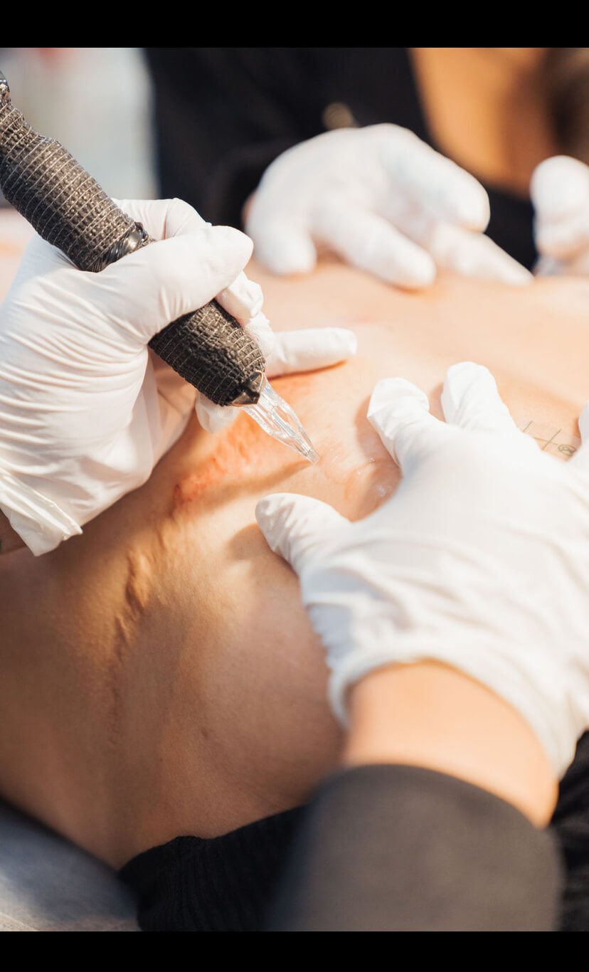 A person receives a tattoo over scarred skin. The tattoo artist is wearing white gloves and holding a tattoo machine.